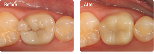 Real performance that outdistances glass ceramics